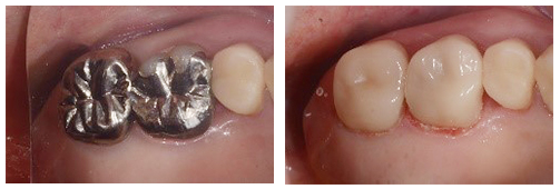 セレック治療画像