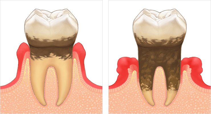 歯周病イメージイラスト
