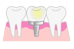 インプラントイラスト